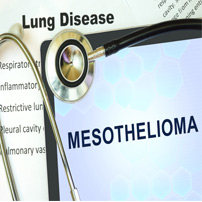 Philadelphia Mesothelioma Lawyers: Tumor Thickness May Predict Treatment Success