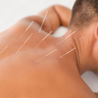 Pennsylvania mesothelioma lawyers discuss the benefits of acupuncture for treating symptoms.