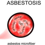 asbestosis