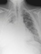 X Ray of Lungs