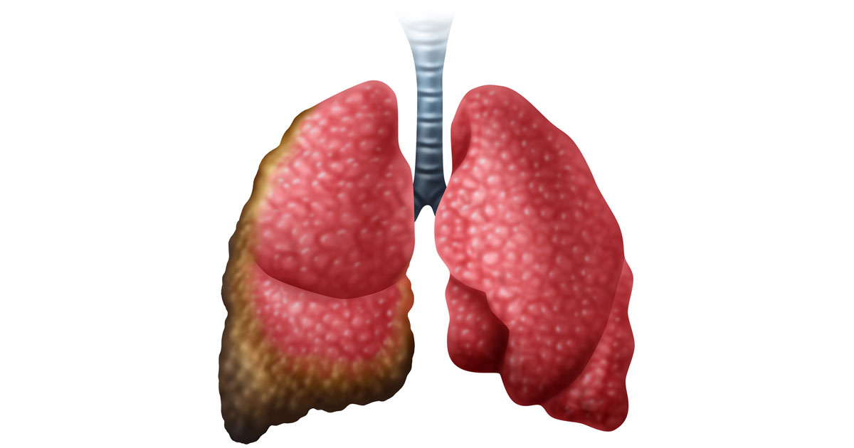 picture of damaged lungs