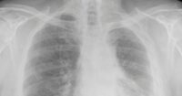 Brookman, Rosenberg, Brown & Sandler: Experienced Philadelphia Mesothelioma Lawyers Who Serve Clients With Compassion and Care